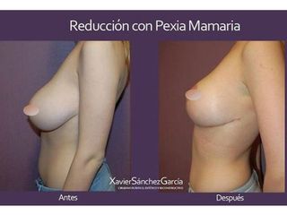Antes y después de Mastopexia