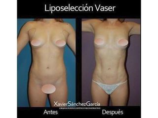 Antes y después de Liposelección Vaser
