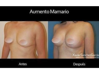 Antes y después de Aumento de busto