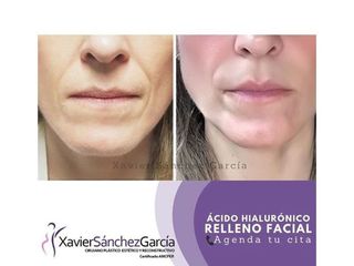 Antes y después de ácido hialurónico relleno facial