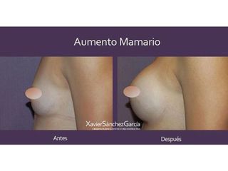 Antes y después de Aumento de busto