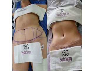 Antes y después de Abdominoplastia
