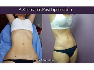 Antes y después de Liposucción