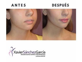 Antes y después de Rinoplastia