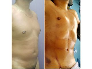 Antes y después de Abdominoplastia