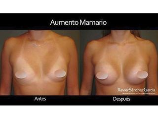 Antes y después de Aumento de busto