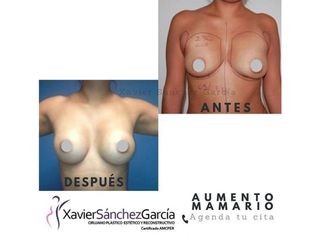 Antes y después de Aumento de busto