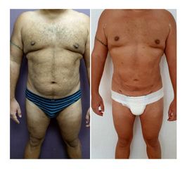 Antes y después de Liposucción Vaser