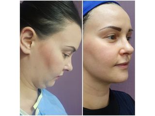 Antes y después de Liposucción de papada 