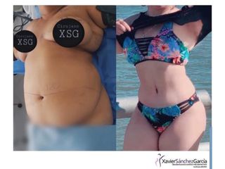Antes y después de Abdominoplastia