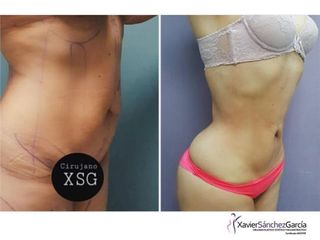 Antes y después de Abdominoplastia