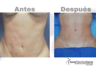 Liposucción