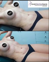 Antes y después de  Liposucción + Aumento de busto