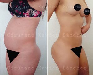 Antes y después de  Liposucción