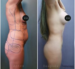 Antes y después de Lipoescultura