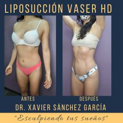 Antes y después de Lipoescultura