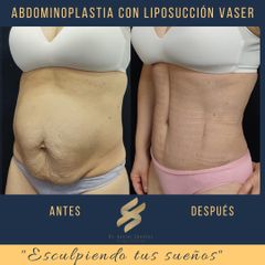 Antes y después de Abdominoplastia