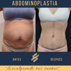 Antes y después de Abdominoplastia