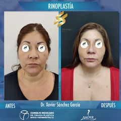 Rinoplastia - Dr. Xavier Sánchez García