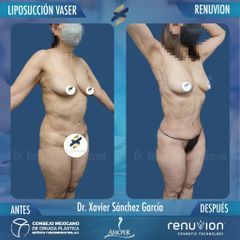 Liposucción - Dr. Xavier Sánchez García