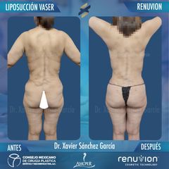 Liposucción