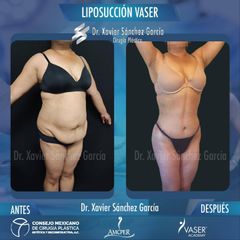Liposucción - Dr. Xavier Sánchez García