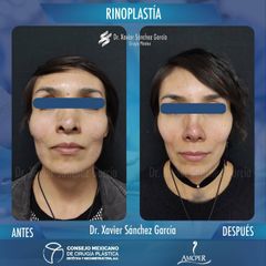 Rinoplastia - Dr. Xavier Sánchez García