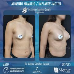 Aumento de busto - Dr. Xavier Sánchez García