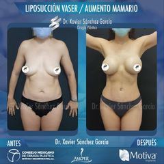 Liposucción - Dr. Xavier Sánchez García