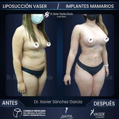 Liposucción - Dr. Xavier Sánchez García
