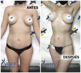 Liposucción - Dr. Xavier Sánchez García