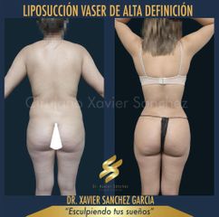 Liposucción  VASER - Dr. Xavier Sánchez García
