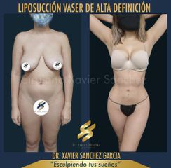 Liposucción  VASER - Dr. Xavier Sánchez García