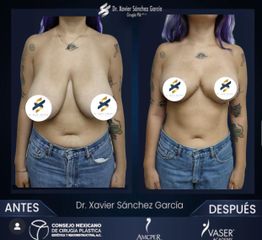 Mastopexia - Dr. Xavier Sánchez García