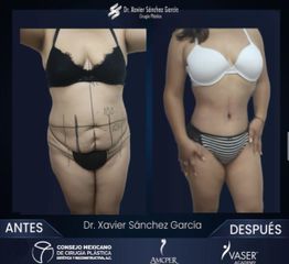 Abdominoplastía 360 - Dr. Xavier Sánchez García