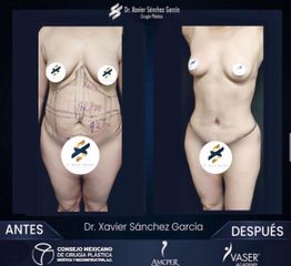 Abdominoplastia 360 - Dr. Xavier Sánchez García