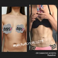 Antes y después de Liposcultura