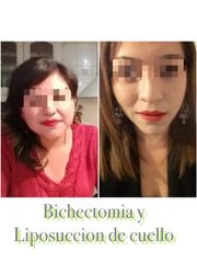 Antes y después de Liposucción de cuello + Bichectomia 