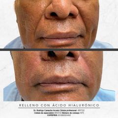 Antes y después de Relleno de surcos nasogenianos 