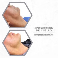 Antes y después de Liposucción de cuello 