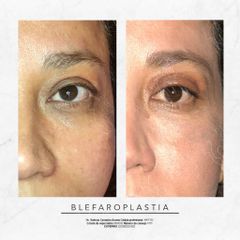 Antes y después de Blefaroplastia 