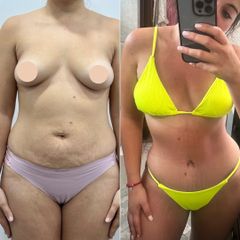 Abdominoplastia - Dr. Rodrigo Camacho Acosta