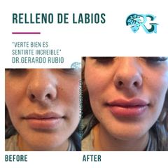 Relleno de Labios - Dr. Gerardo Rubio