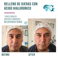 Relleno de Ojeras - Dr. Gerardo Rubio
