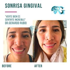 Sonrisa Gingival - Dr. Gerardo Rubio