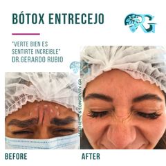 Bótox entrecejo - Dr. Gerardo Rubio