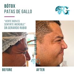 Bótox Orbiculares - Dr. Gerardo Rubio