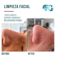 Limpieza Facial Mecánica