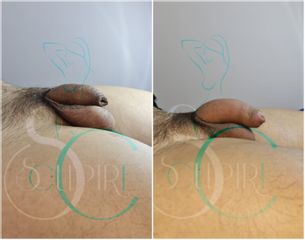 Engrosamiento de pene - Medical Sculpiré