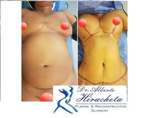 Antes y después de Mommy Makeover